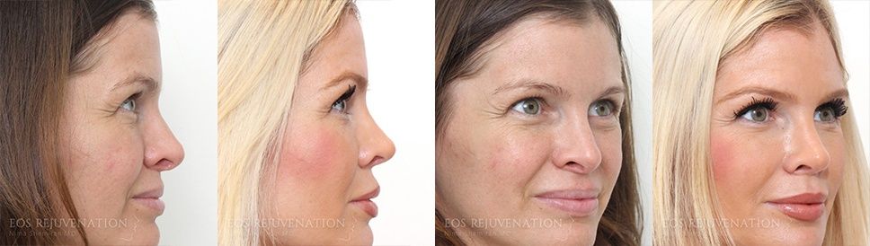 Rhinoplasty to Improve Appearance and Function of the Nose