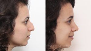 Chin Augmentation and Rhinoplasty Combined for Balance and Perfection