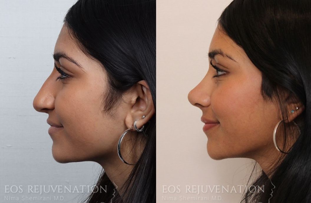 beverly hills rhinoplasty before and after