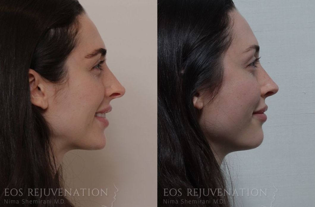 beverly hills revision rhinoplasty before and after