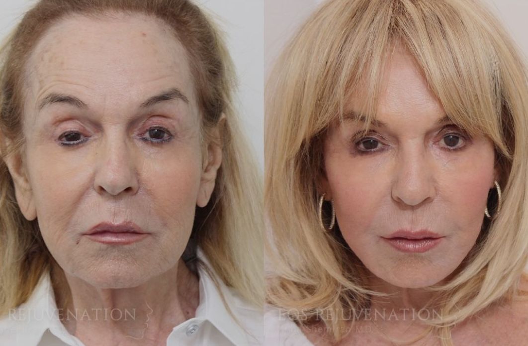 beverly hills facelift before and after