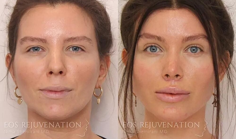 Rhinoplasty Before & After