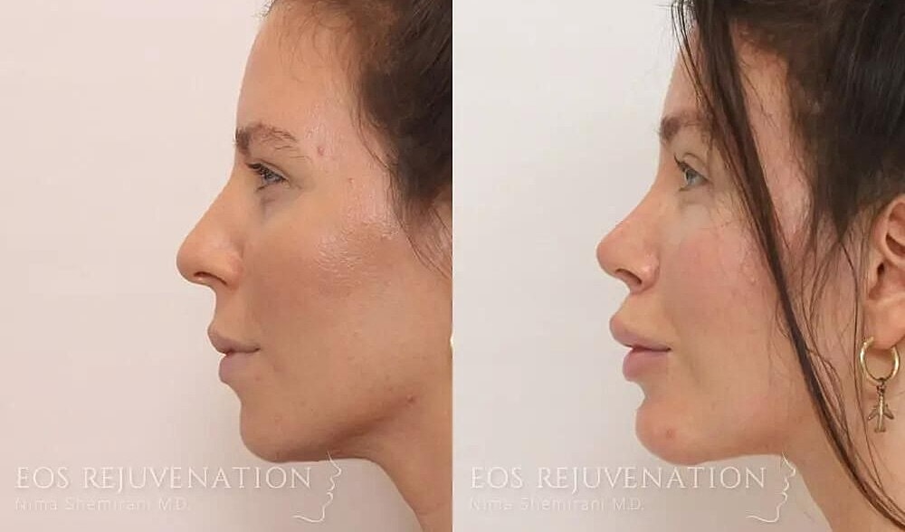 Rhinoplasty Before & After