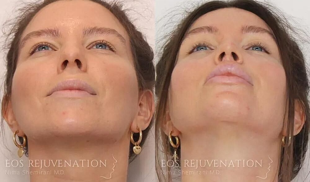 Rhinoplasty Before & After