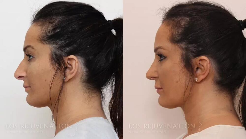 Rhinoplasty Before & After