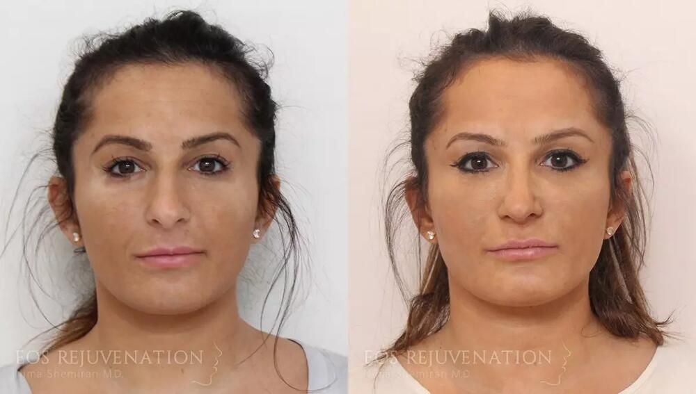 Rhinoplasty Before & After