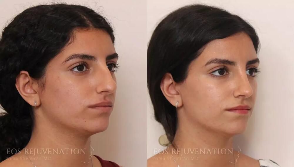 Rhinoplasty Before & After