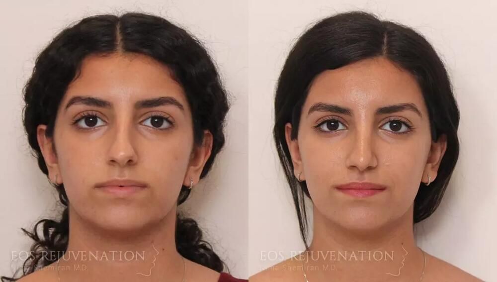Rhinoplasty Before & After