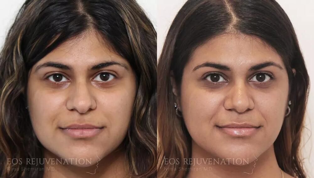 Rhinoplasty Before & After