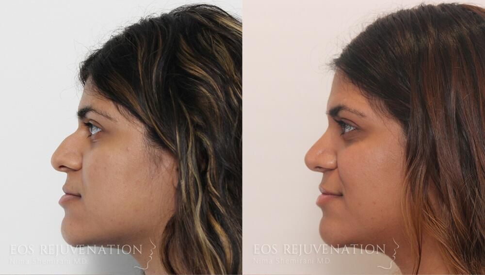 Rhinoplasty Before & After