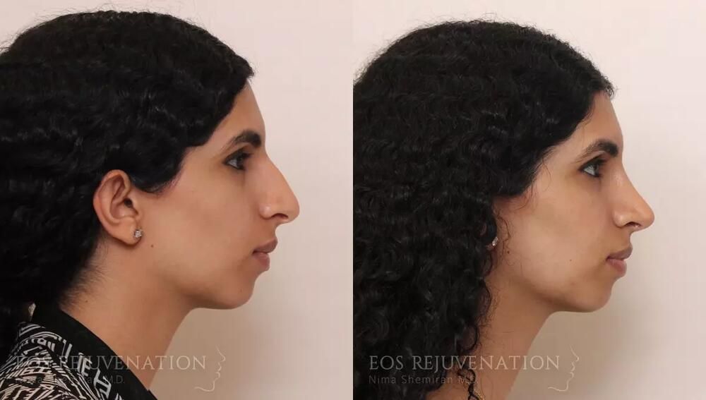 Rhinoplasty Before & After