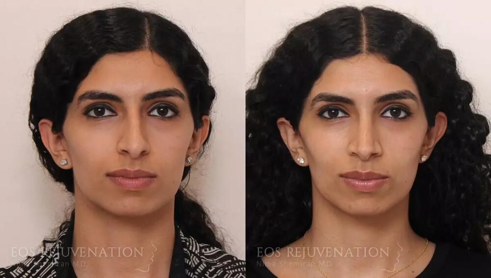Rhinoplasty Before & After