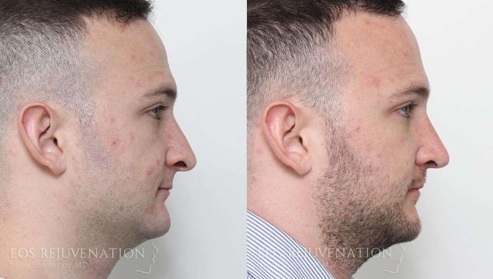 Rhinoplasty Before & After