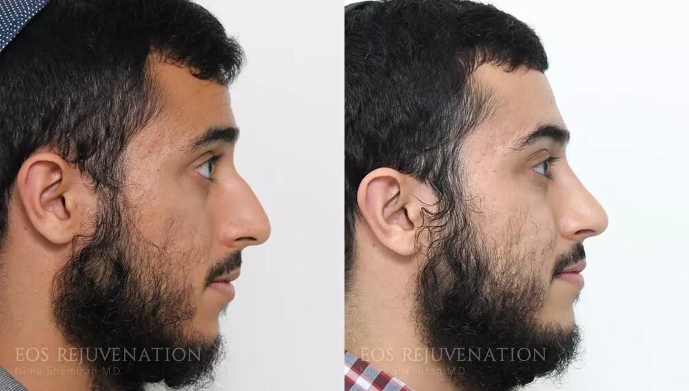 Rhinoplasty Before & After