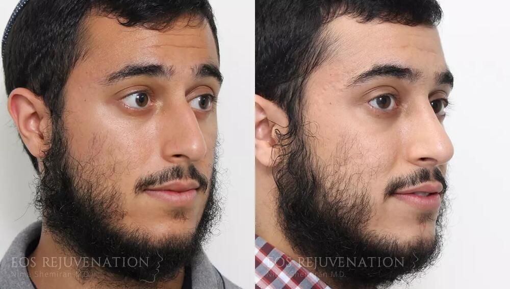 Rhinoplasty Before & After