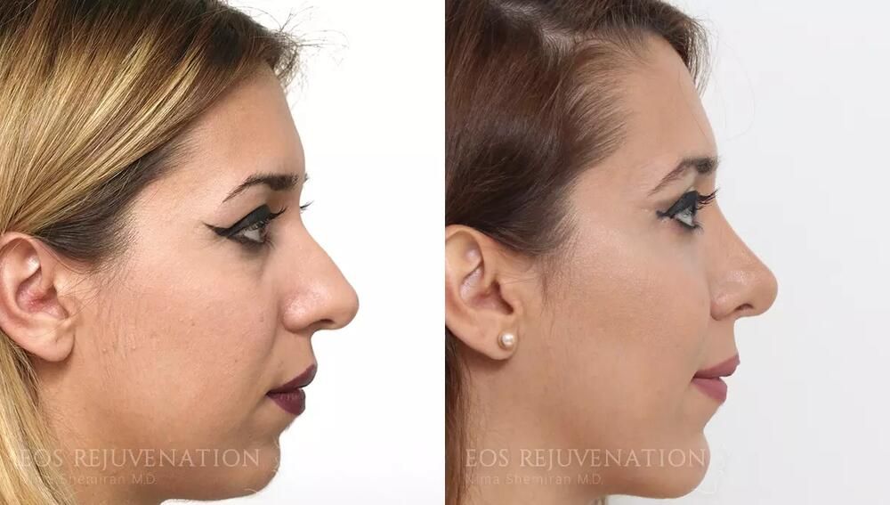 Rhinoplasty Before & After