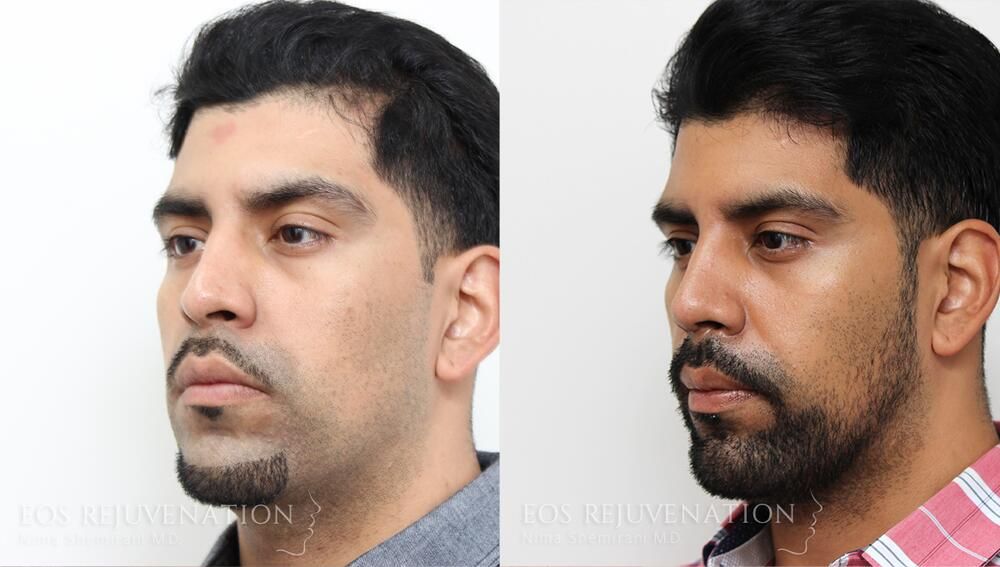 Rhinoplasty Before & After