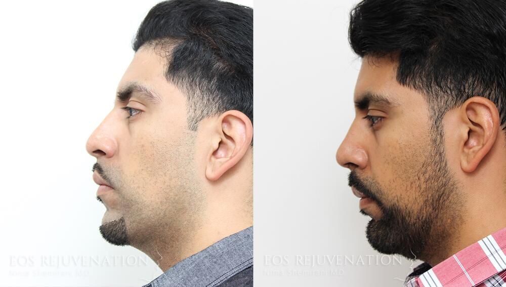Rhinoplasty Before & After