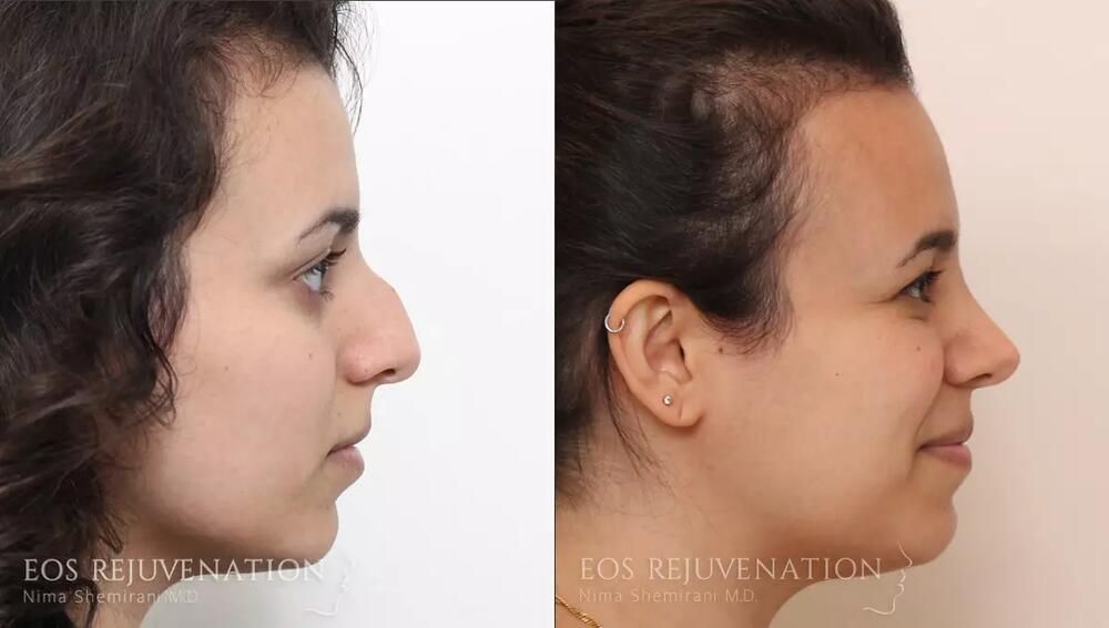 Rhinoplasty Before & After
