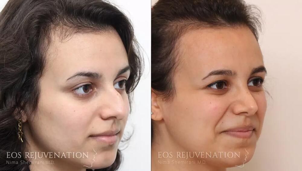 Rhinoplasty Before & After