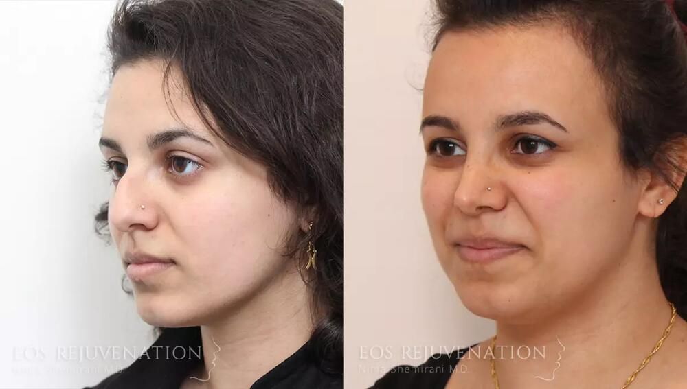 Rhinoplasty Before & After