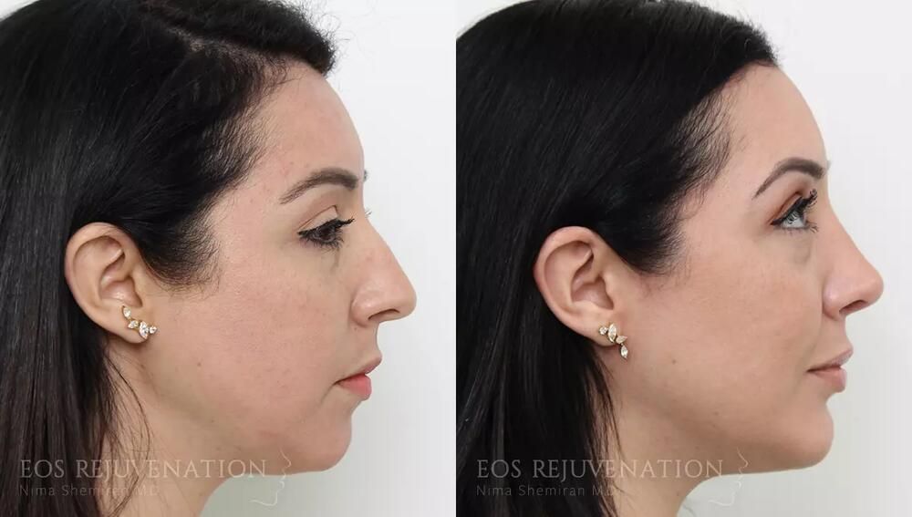 Rhinoplasty Before & After