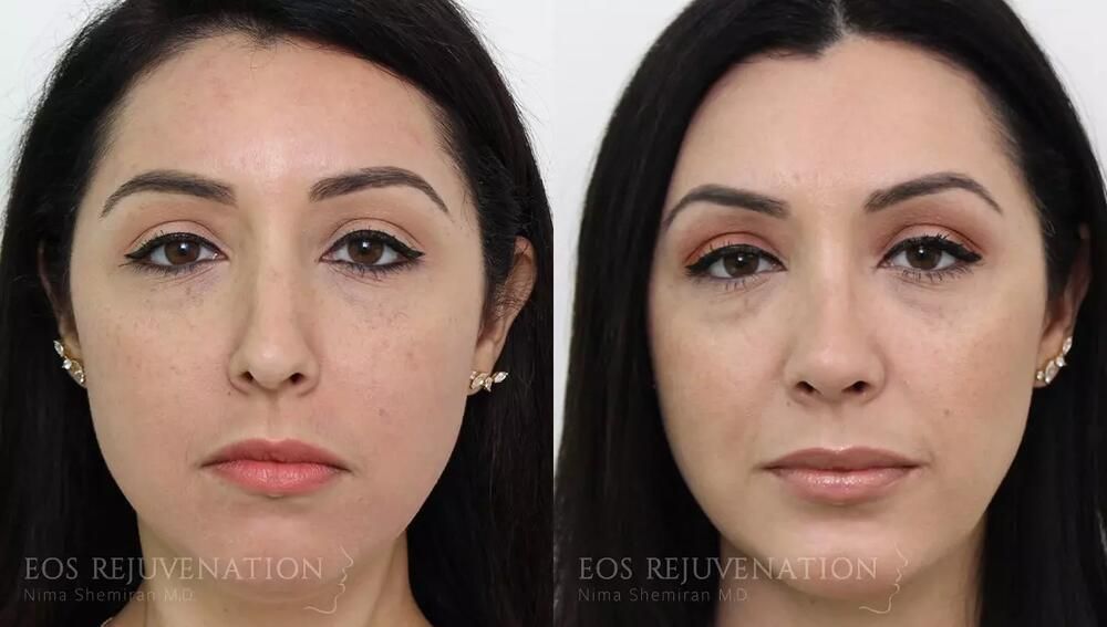 Rhinoplasty Before & After