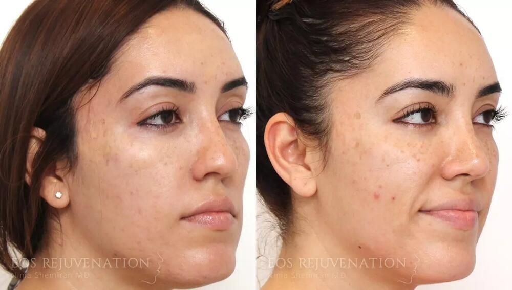 Rhinoplasty Before & After