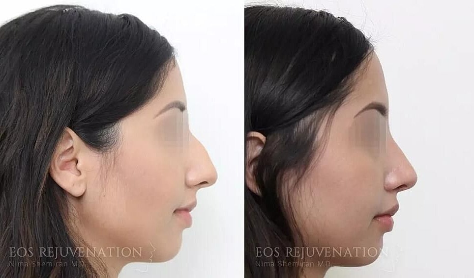 Rhinoplasty Before & After