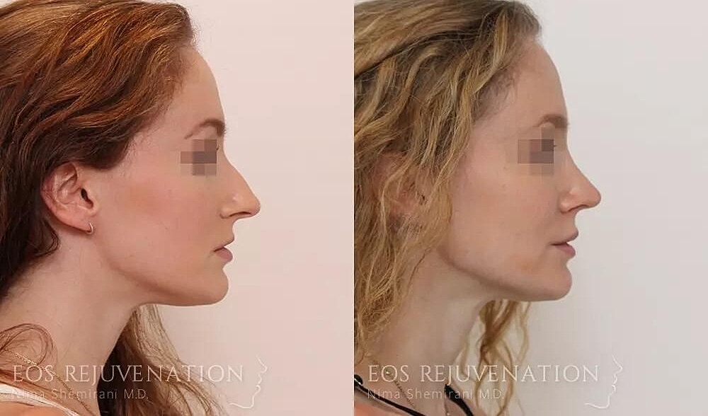 Rhinoplasty Before & After