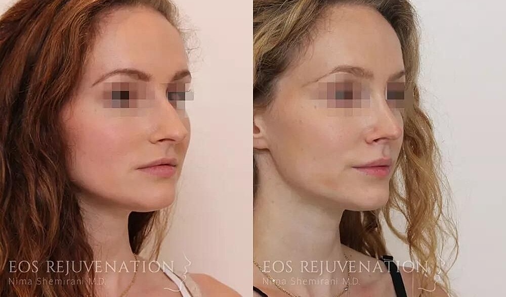 Rhinoplasty Before & After