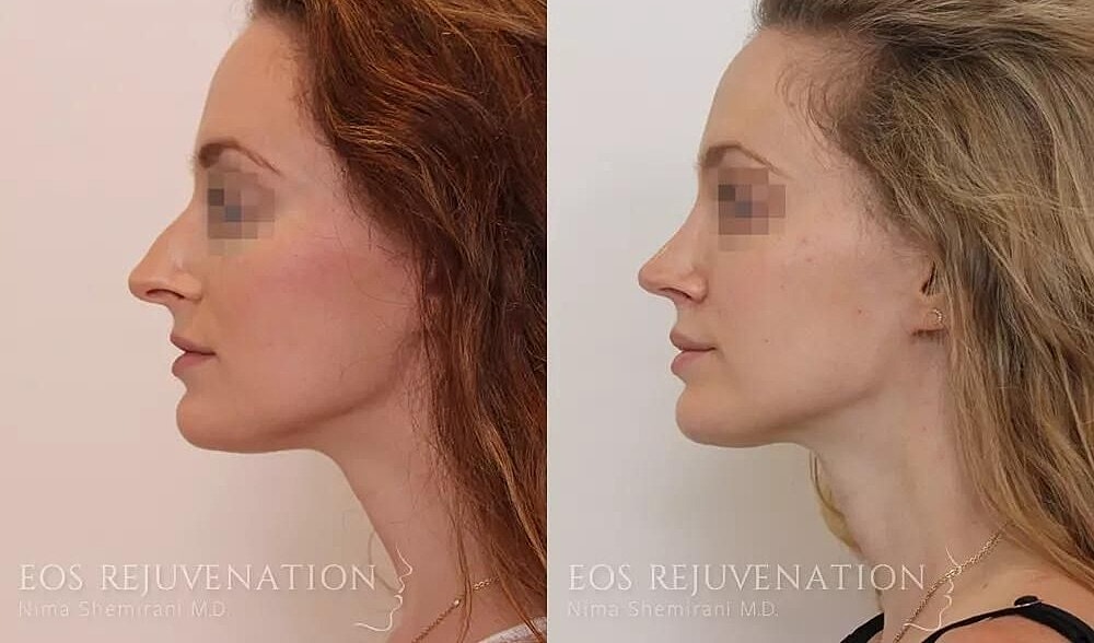 Rhinoplasty Before & After