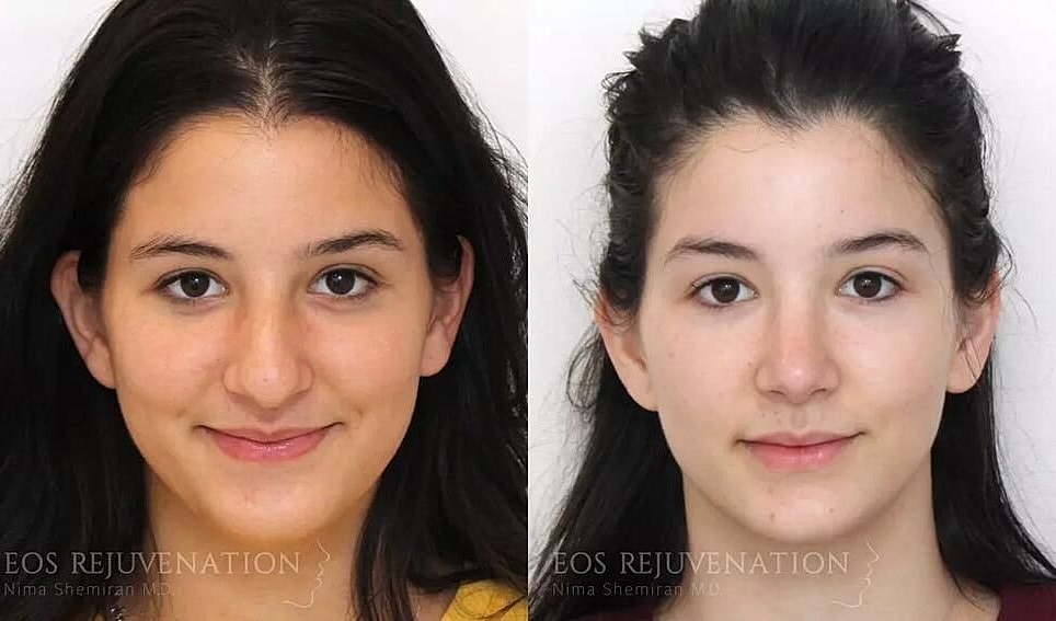 Rhinoplasty Before & After