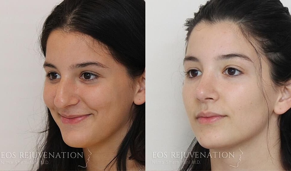 Rhinoplasty Before & After