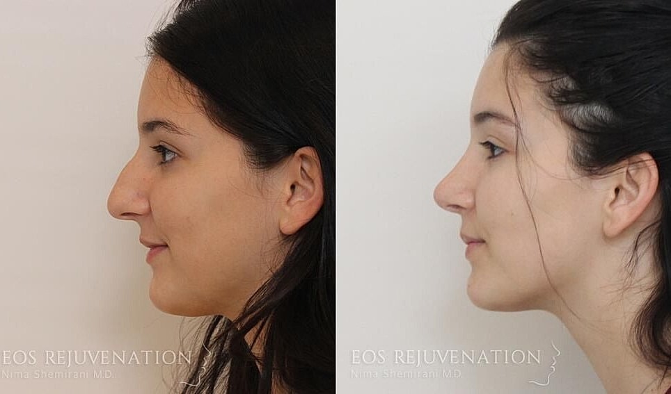 Rhinoplasty Before & After