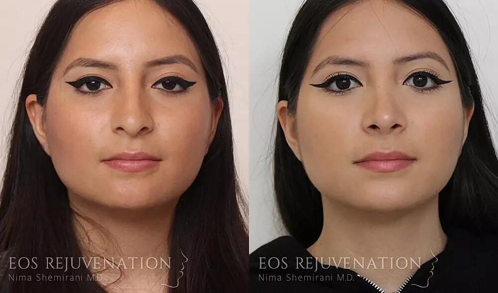 Rhinoplasty Before & After
