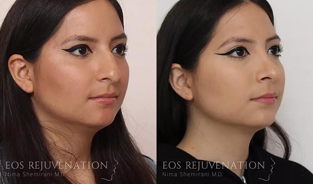 Rhinoplasty Before & After
