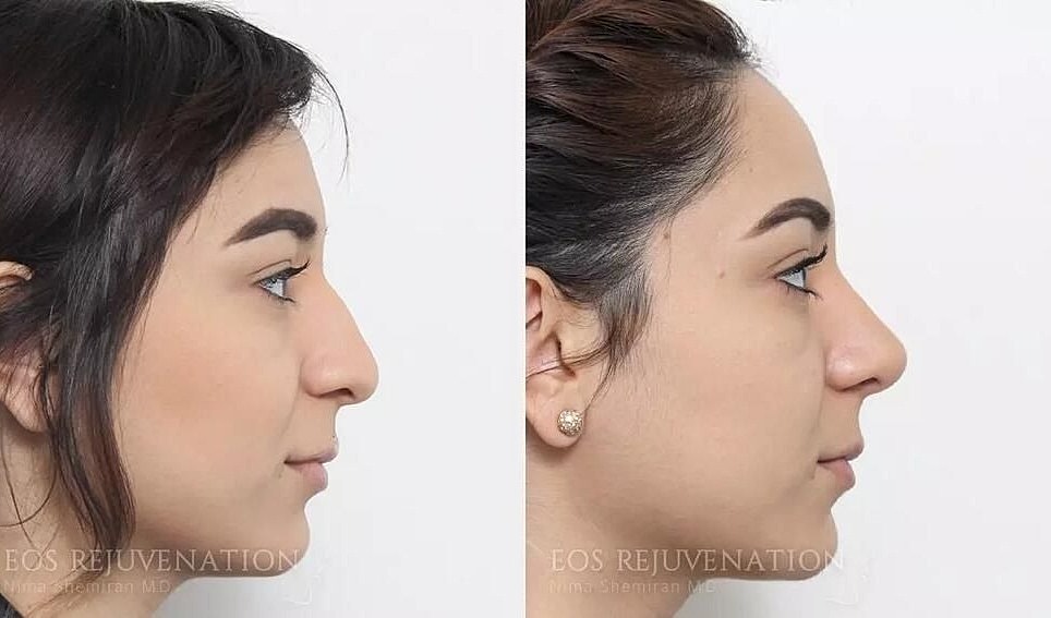 Rhinoplasty Before & After