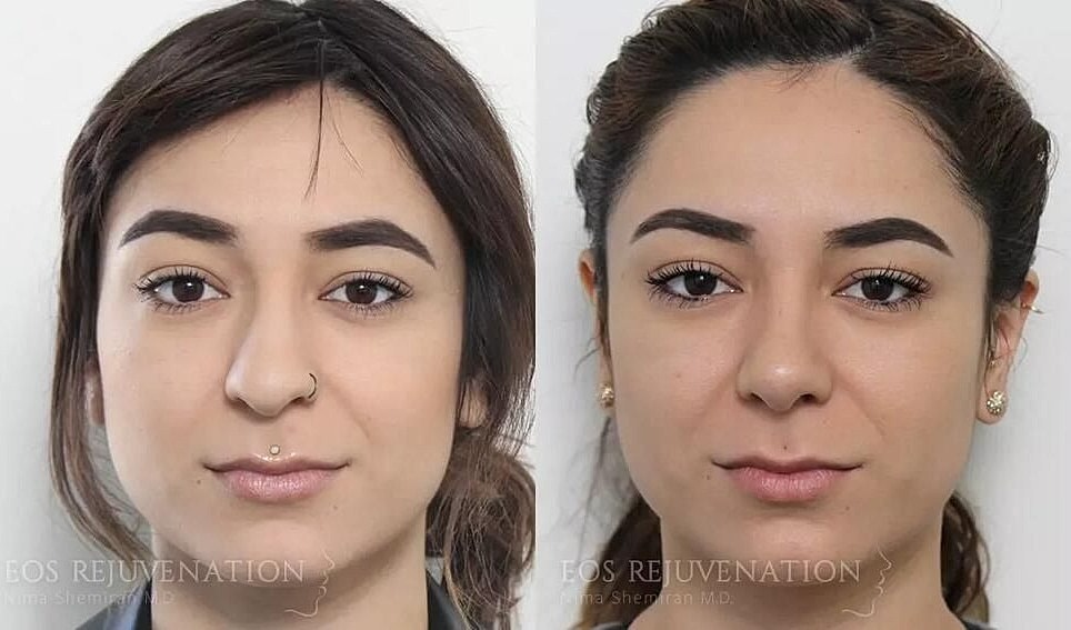 Rhinoplasty Before & After