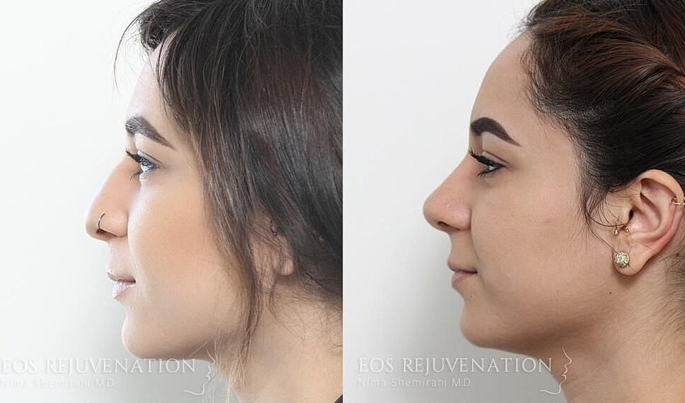 Rhinoplasty Before & After