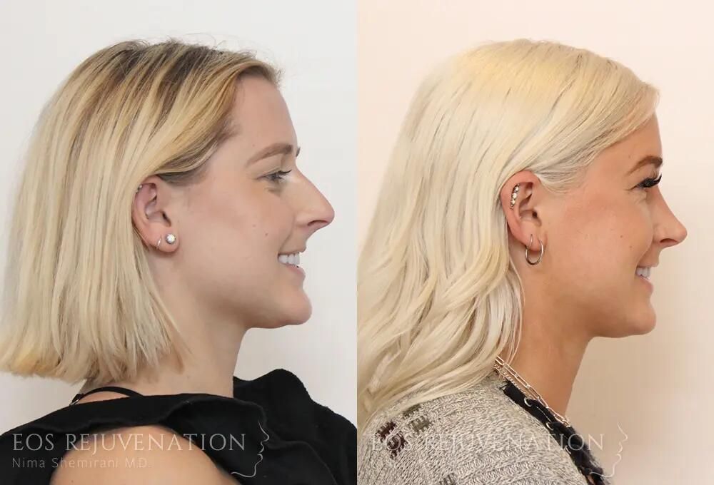 Rhinoplasty Before & After