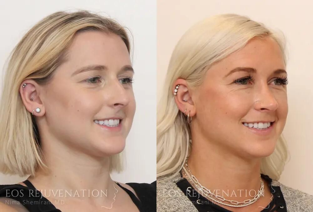 Rhinoplasty Before & After
