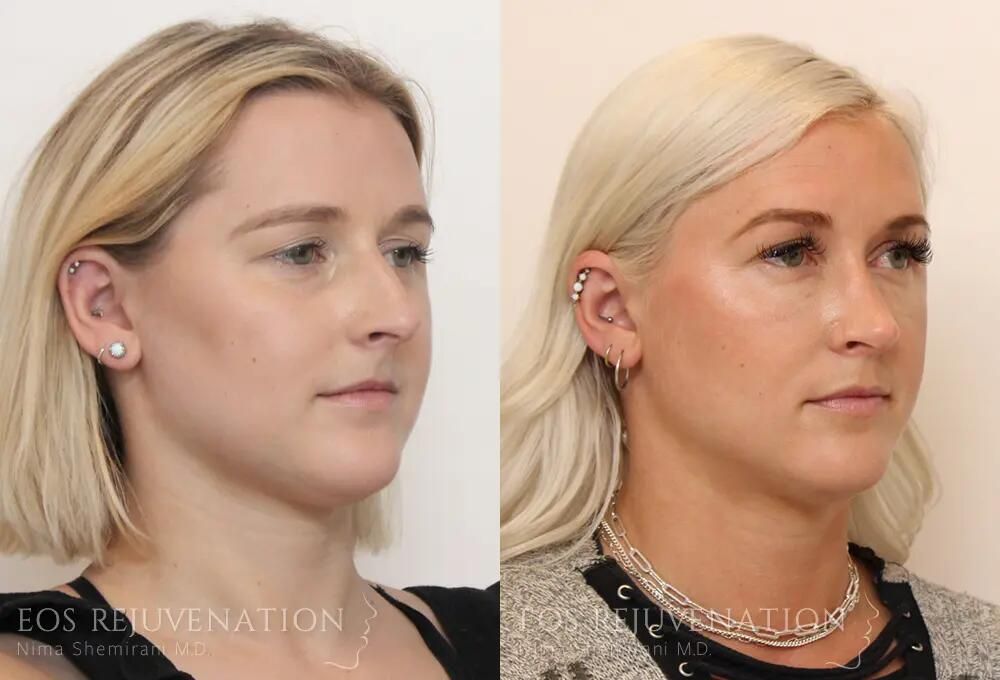 Rhinoplasty Before & After