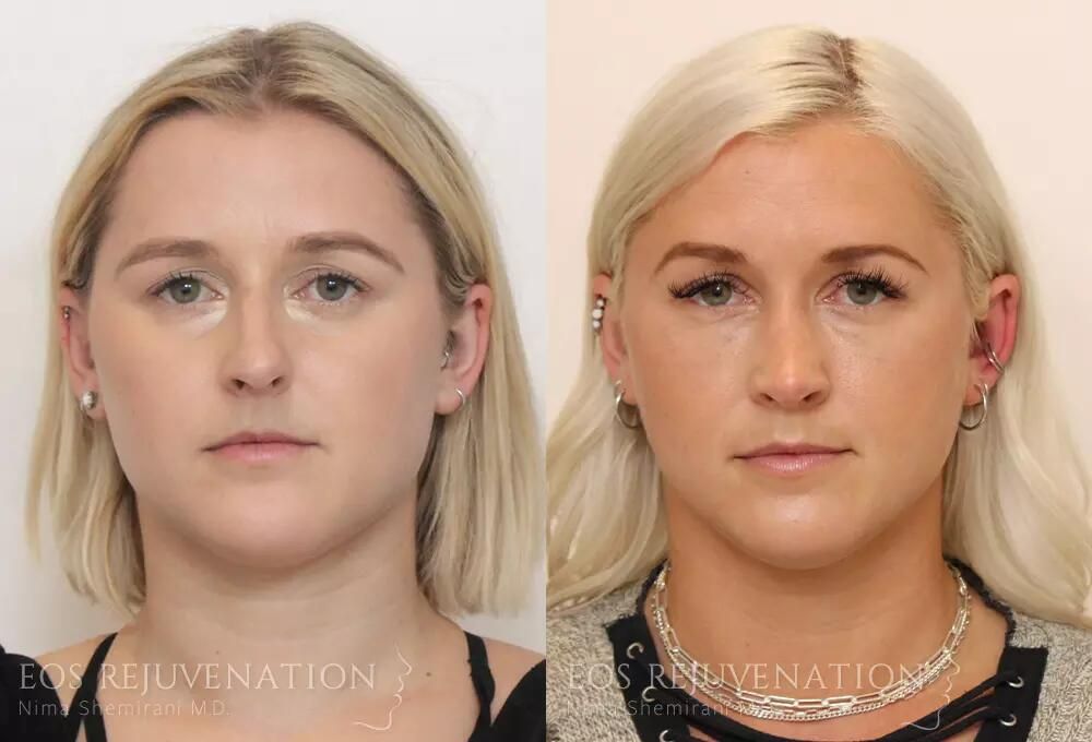Rhinoplasty Before & After