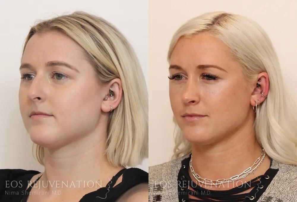 Rhinoplasty Before & After