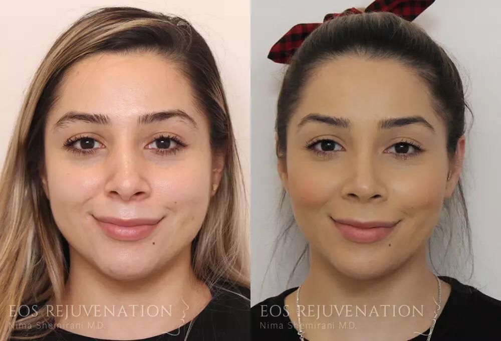 Rhinoplasty Before & After