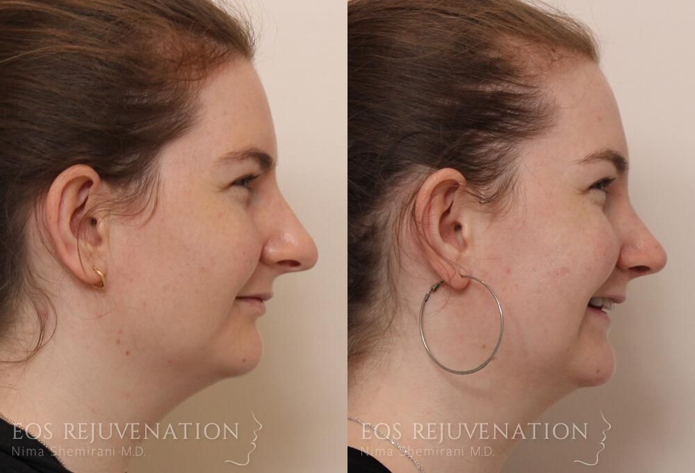 Rhinoplasty Before & After