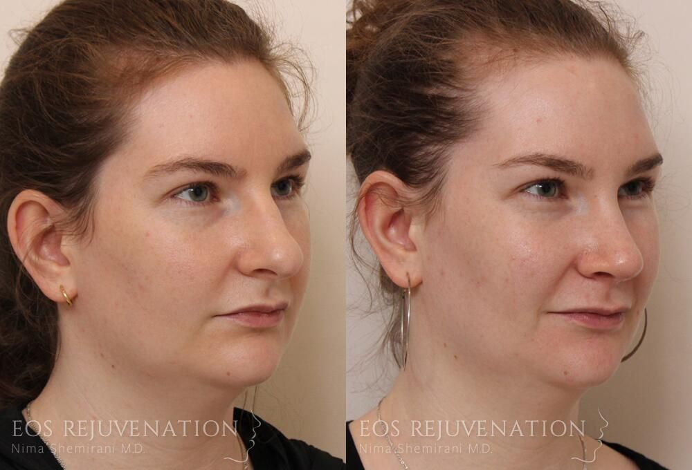 Rhinoplasty Before & After