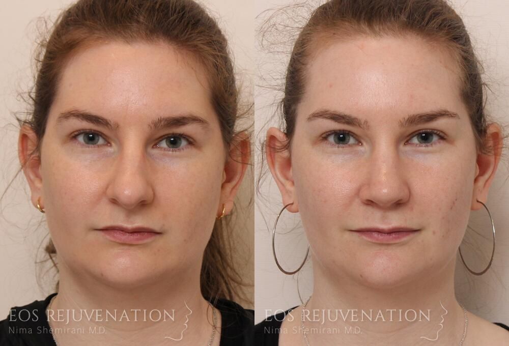 Rhinoplasty Before & After
