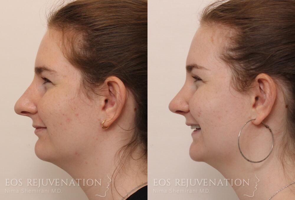 Rhinoplasty Before & After